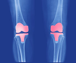 total knee replacement