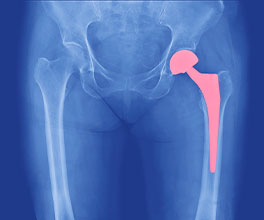 total hip replacement