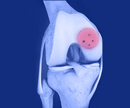 cartilage transplantation by dr vahid vahabzadeh